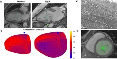 Imminent risk of LVEF decline in asymptomatic patients with primary mitral regurgitation